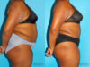 Liposuction case #5885 slider thumbnail