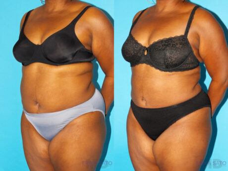 Liposuction case #5885