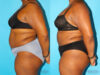Liposuction case #5885 slider thumbnail