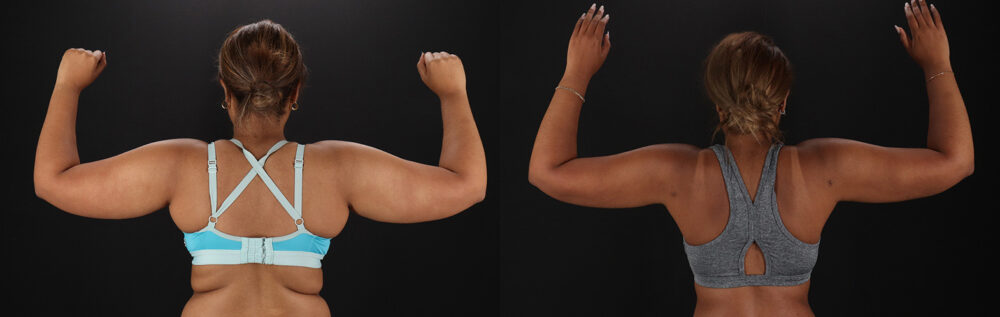 Brazilian Butt Lift case #5513