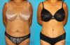 Tummy Tuck case #7233 slider thumbnail