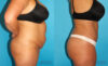 Tummy Tuck case #7280 slider thumbnail