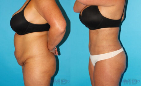 Tummy Tuck case #7280