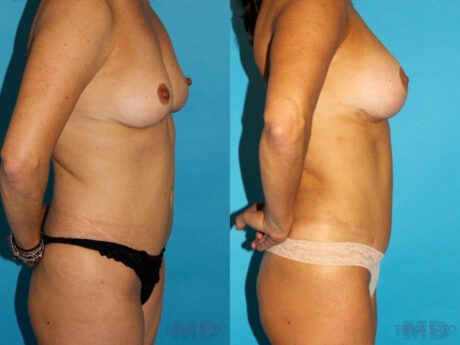 Liposuction case #5886