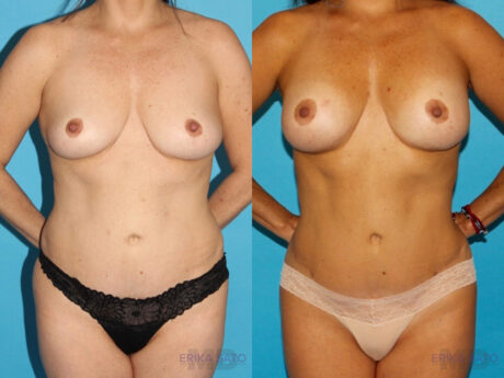 Liposuction case #5886