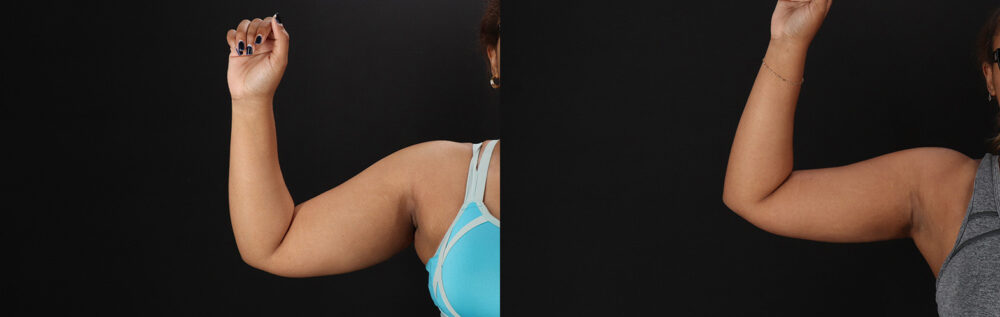 Brazilian Butt Lift case #5513