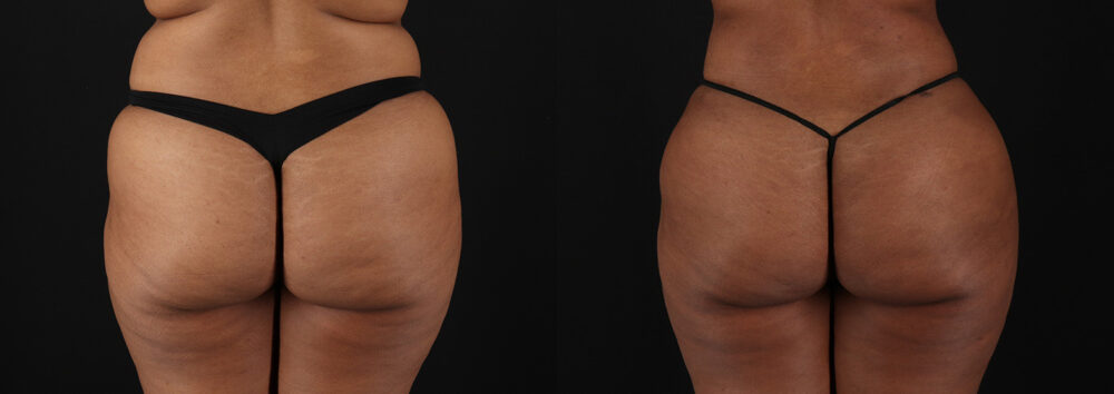 Brazilian Butt Lift case #5513