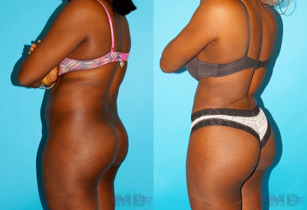 Brazilian Butt Lift case #4762