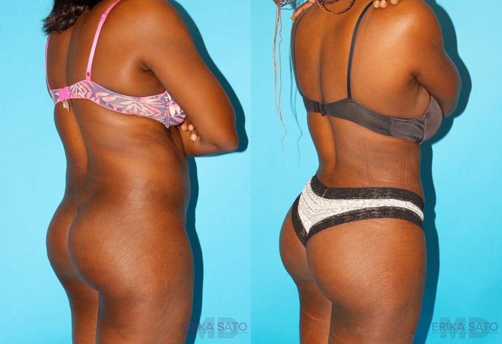 Brazilian Butt Lift case #4762