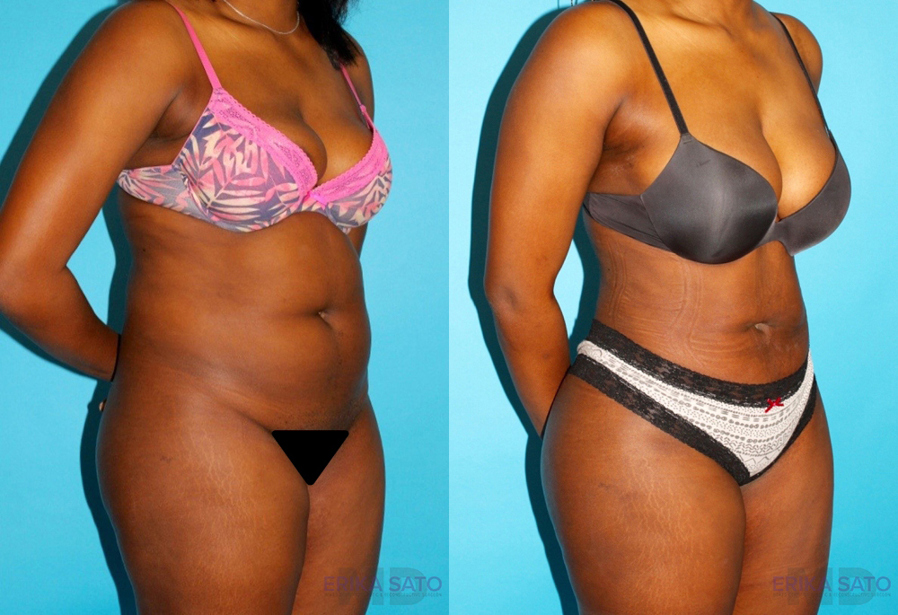 Brazilian Butt Lift case #4762