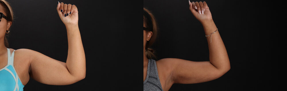 Brazilian Butt Lift case #5513