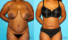 Liposuction case #5888 slider thumbnail