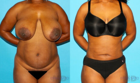Liposuction case #5888