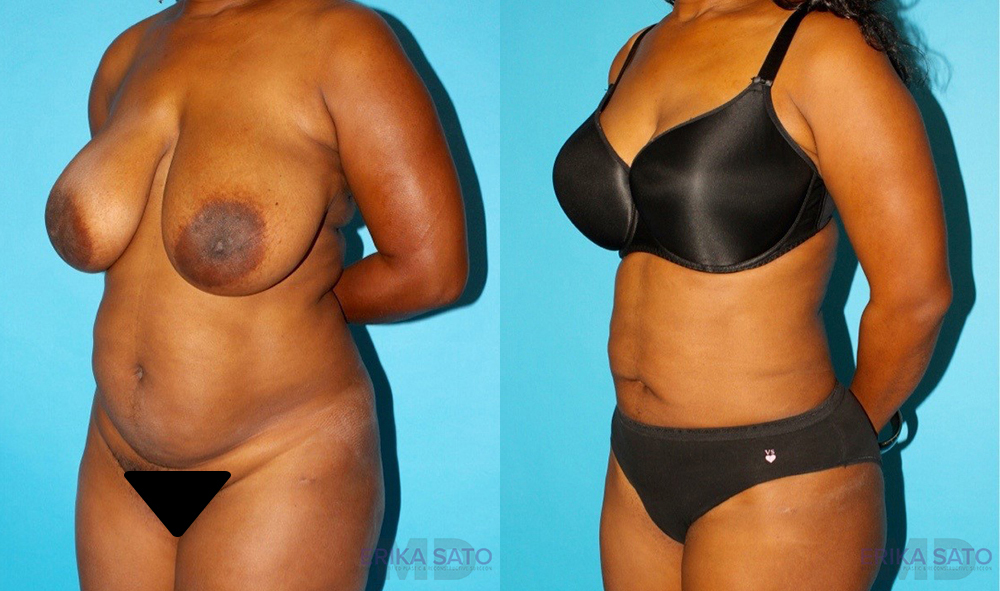 Liposuction case #5888