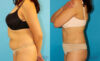 Liposuction case #5887 slider thumbnail