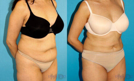 Liposuction case #5887