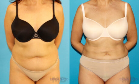 Liposuction case #5887