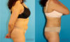 Liposuction case #5887 slider thumbnail
