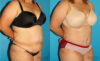 Tummy Tuck case #7167 slider thumbnail
