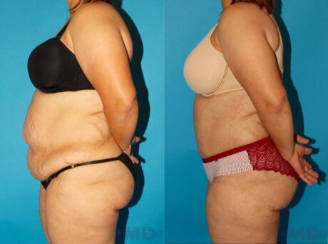 Tummy Tuck case #7167