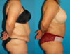 Tummy Tuck case #7167 slider thumbnail