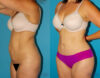 Tummy Tuck case #7169 slider thumbnail