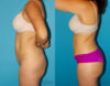 Tummy Tuck case #7169 slider thumbnail