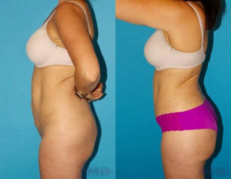 Tummy Tuck case #7169