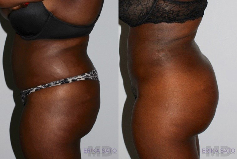 Brazilian Butt Lift case #4625