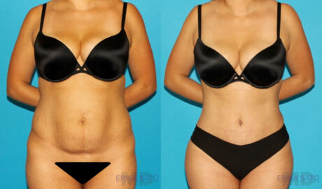 Tummy Tuck case #7340