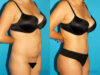 Tummy Tuck case #7340 slider thumbnail