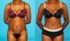 Tummy Tuck case #7275 slider thumbnail