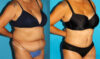 Tummy Tuck case #7170 slider thumbnail