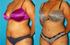 Tummy Tuck case #7279 slider thumbnail