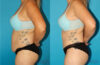 Tummy Tuck case #7278 slider thumbnail