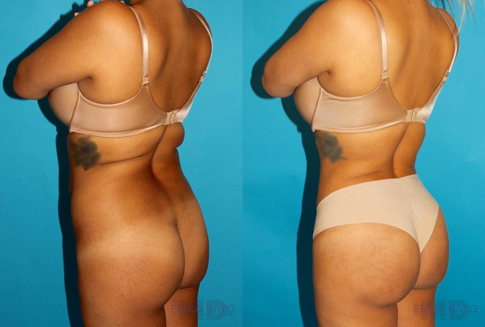 Brazilian Butt Lift case #4616