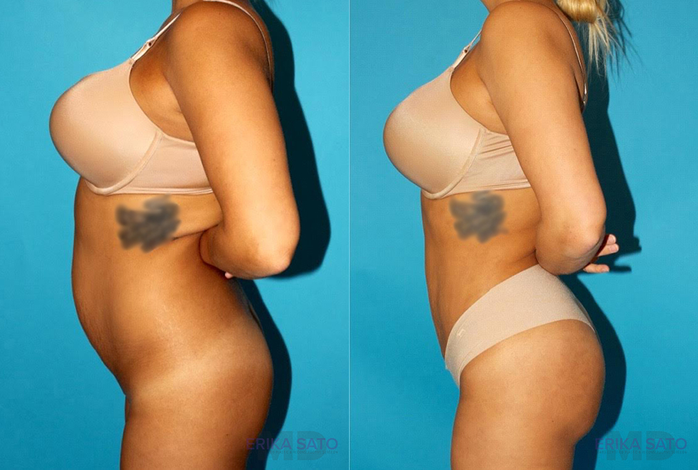 Brazilian Butt Lift case #4616