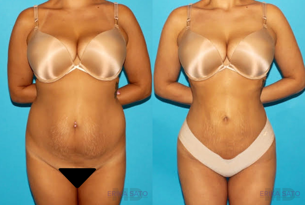 Brazilian Butt Lift case #4616