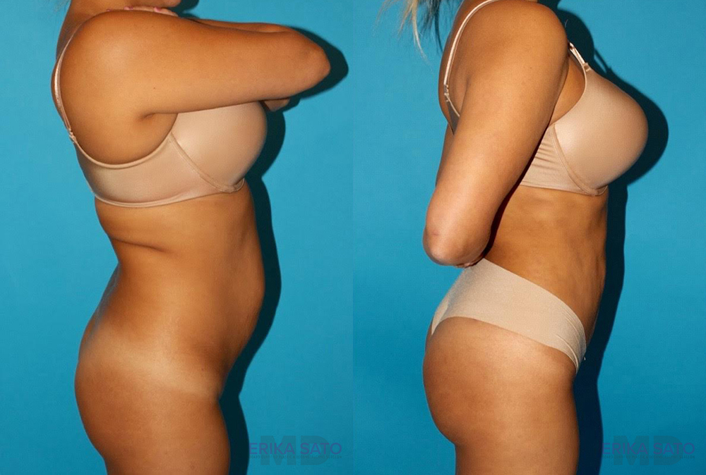 Brazilian Butt Lift case #4616