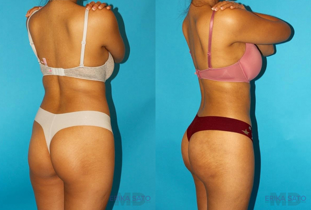 Brazilian Butt Lift case #4767