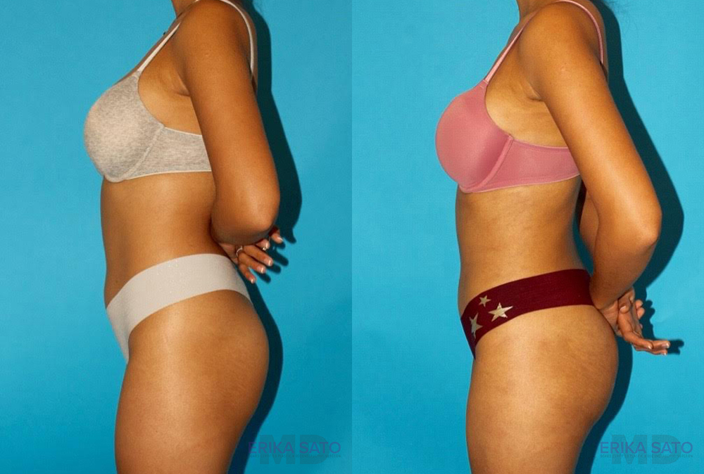 Brazilian Butt Lift case #4767