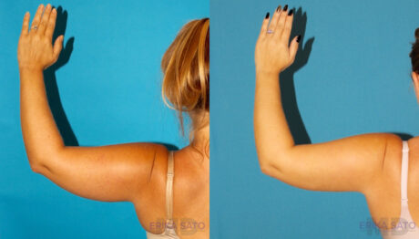 Liposuction case #5893