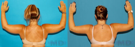 Liposuction case #5893