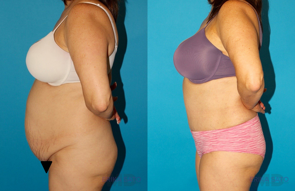 Tummy Tuck case #7171