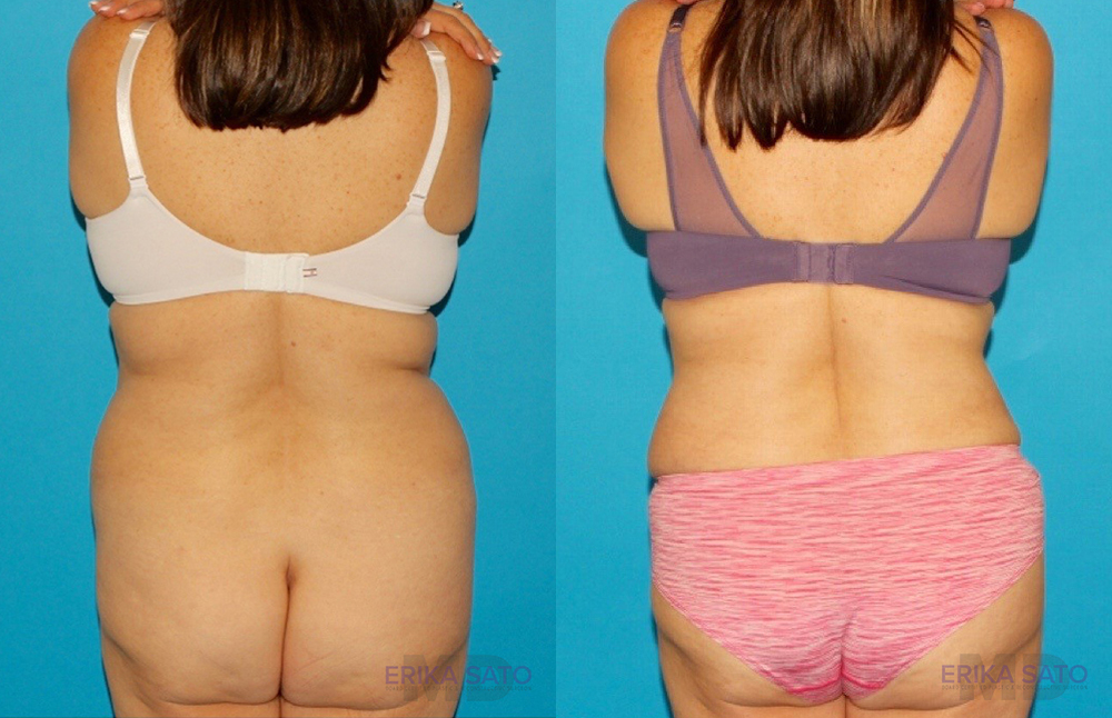 Tummy Tuck case #7171