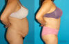 Tummy Tuck case #7171 slider thumbnail