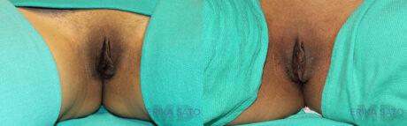 Labiaplasty case #5539