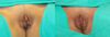 Labiaplasty case #5538 slider thumbnail