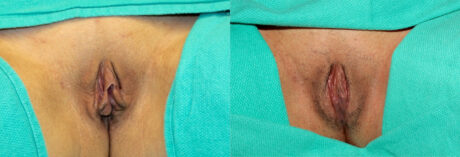 Labiaplasty case #5538