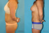 Liposuction case #5883 slider thumbnail